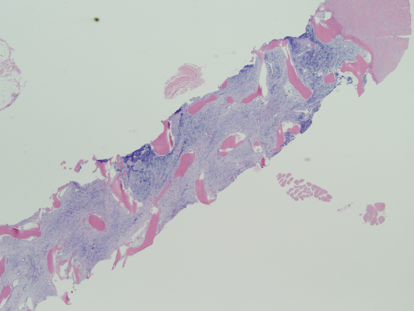 Microscopic image 3 - Biopsy from bone marrow, 2x (Click to enlarge)